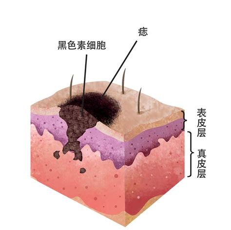 痣的形成原因|痣是什麼？一次了解痣原因、就醫時機以及如何改善